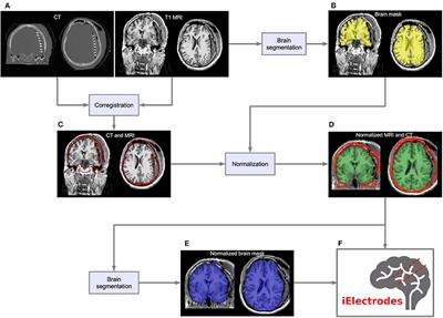 iElectrodes: A Comprehensive Open-Source Toolbox for Depth and Subdural Grid Electrode Localization